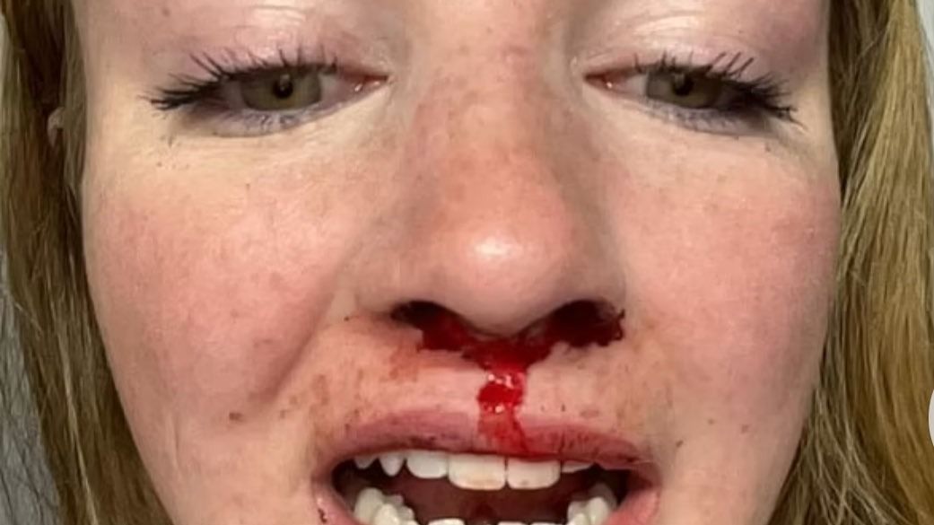 Lesbian Couple Celebrating Birthday Gets Thrashed by Mob in Canada, Sustains Injuries