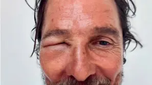 Interstellar Actor Matthew McConaughey Gets Swolen Eye From Bee Sting, Photo Goes Viral Matthew McConaughey Stung By Bee