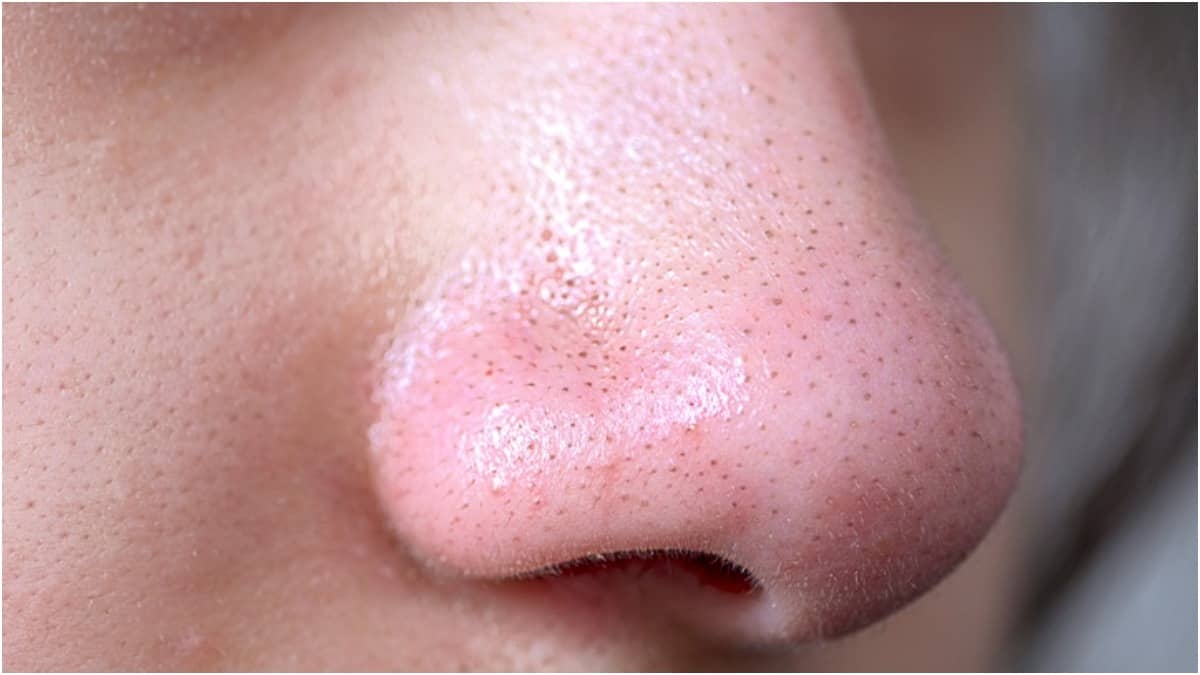 Blackheads are more common in people with oily skin