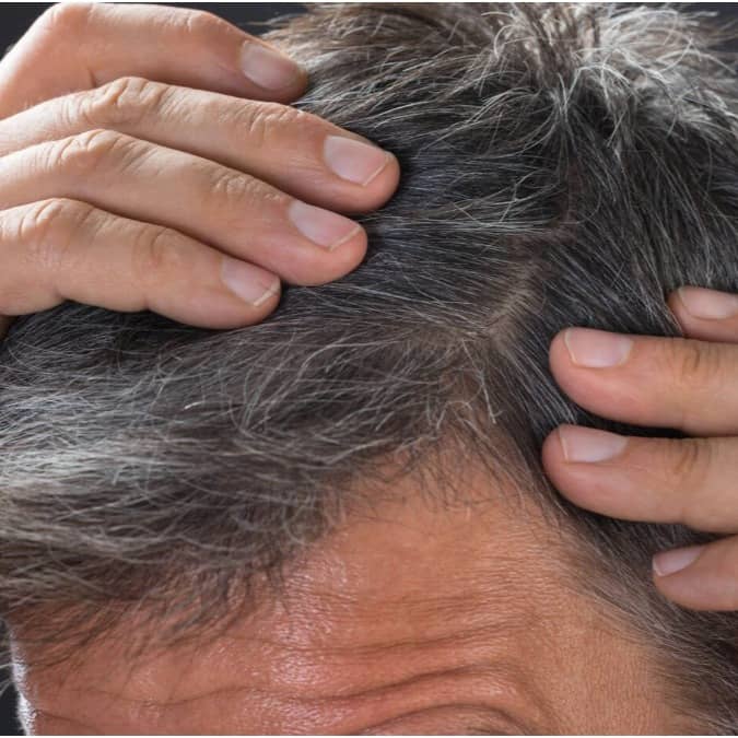 Genetics and stress can cause premature greying of hair