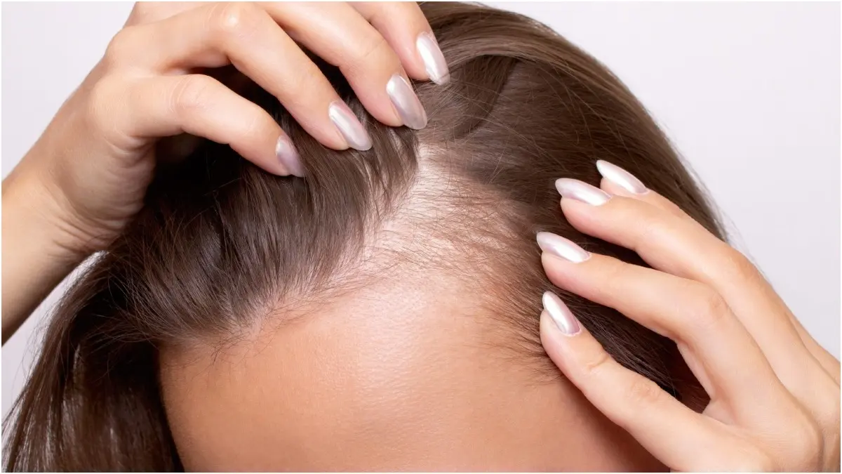 Experiencing Sudden Hair Loss? These Medical Conditions Could Be The Reason Behind It Hair loss among men and women of all ages is quite common these days