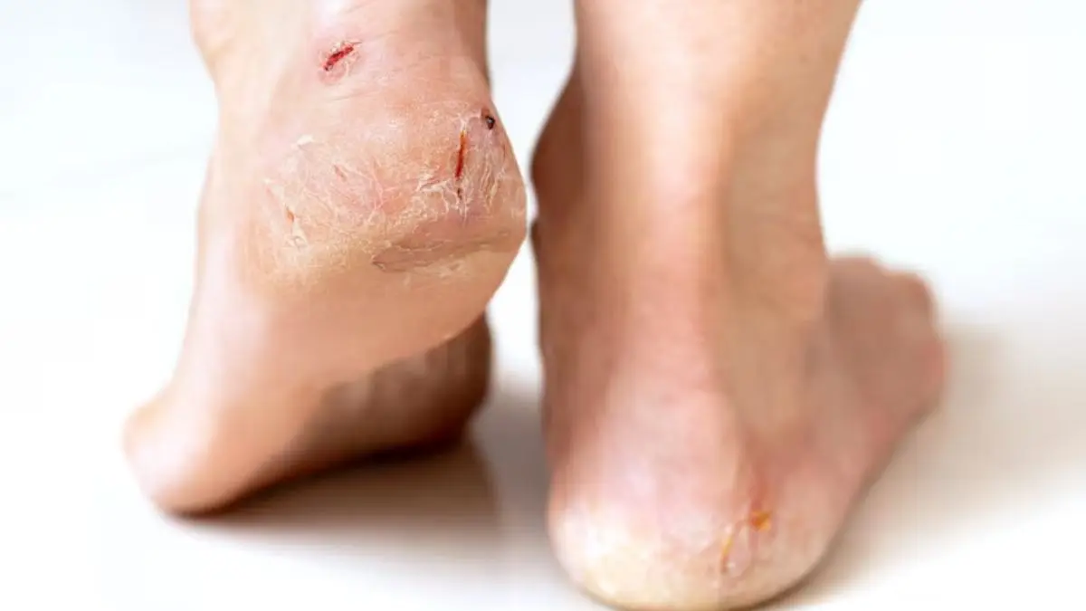 Homemade Foot Cream: गर्मियों में फटी एड़ियों का आ गया रामबाण इलाज, ये आसान घरेलू नुस्खा देगा चुटकियों में राहत homemade foot cream