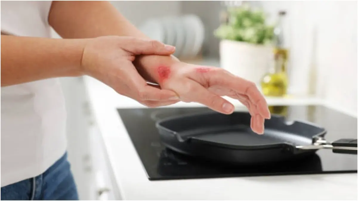 Kitchen Burns: How To Take Care Of Your Skin To Avoid Permanent Scarring? If untreated, kitchen burns can cause permanent scarring