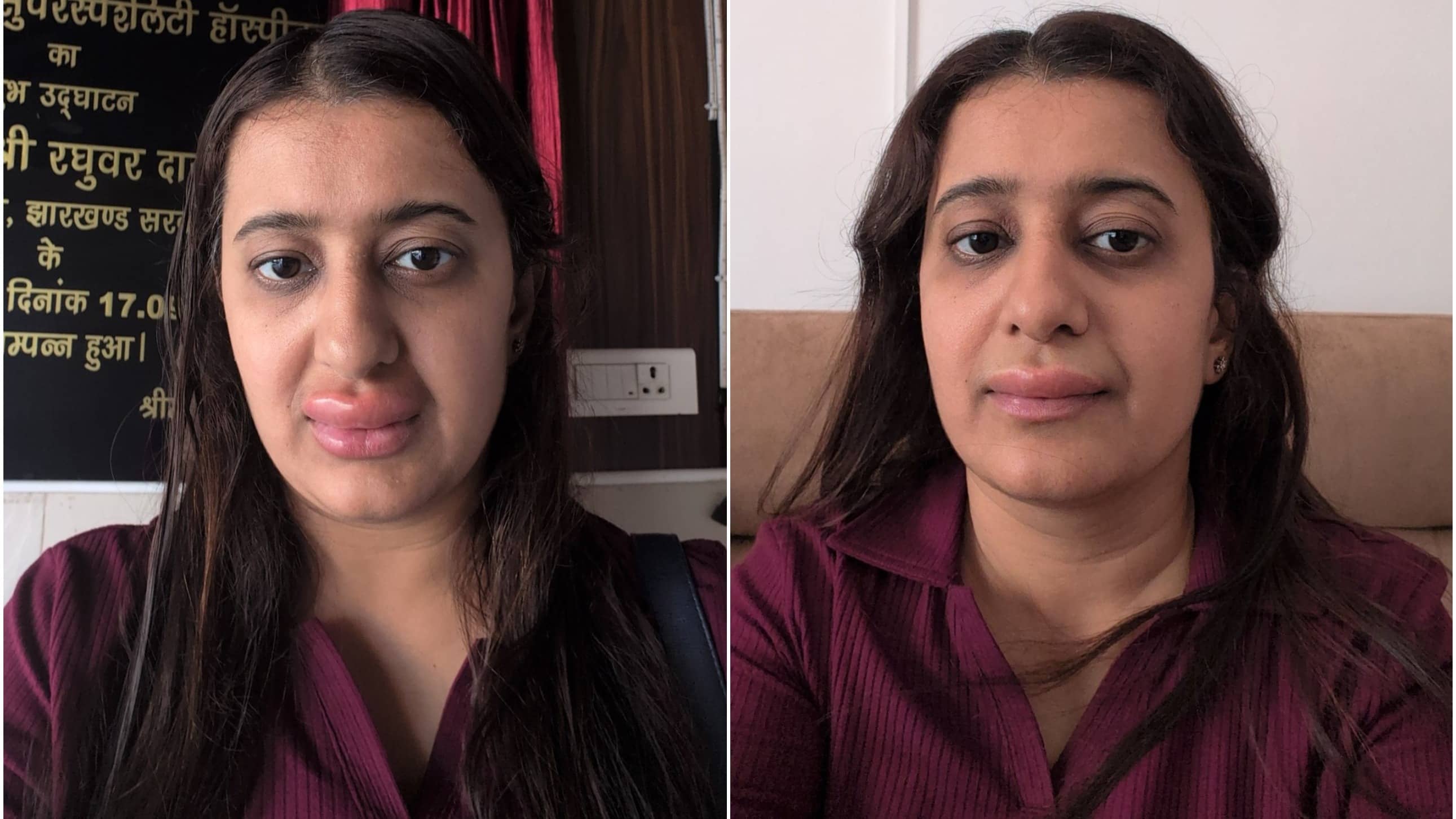 'Lips Started Swelling...': Woman Alleges After Eating Vande Bharat Food; IRCTC Replies To Viral Post