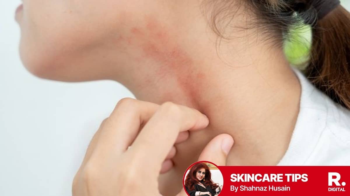 Summer season beckons skin problems like acne, tanning, sunburn and more