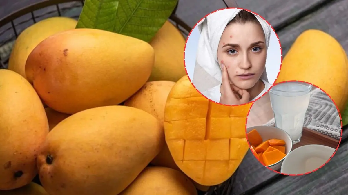 Still Avoiding Mango In Summers To Prevent Acne Breakout? Mira Kapoor Has The Perfect 2-Ingredient Hack Mira Rajput's hack against mango acne