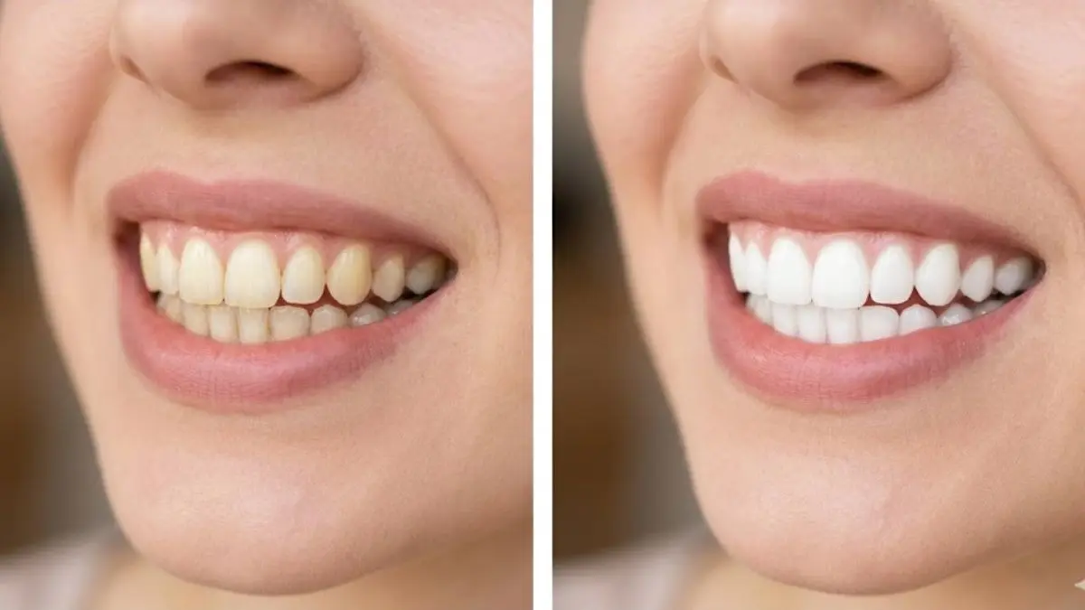 Yellow Teeth Home Remedies: दांतों का पीलापन दूर करने का रामबाण उपाय, बस इस फल के छिलके का करें इस्तेमाल! banana-peel-remove-yellow-teeth-home-remedies-baking-soda-coconut-oil-peele-dant-kaise-saaf-kare-easy-remedies