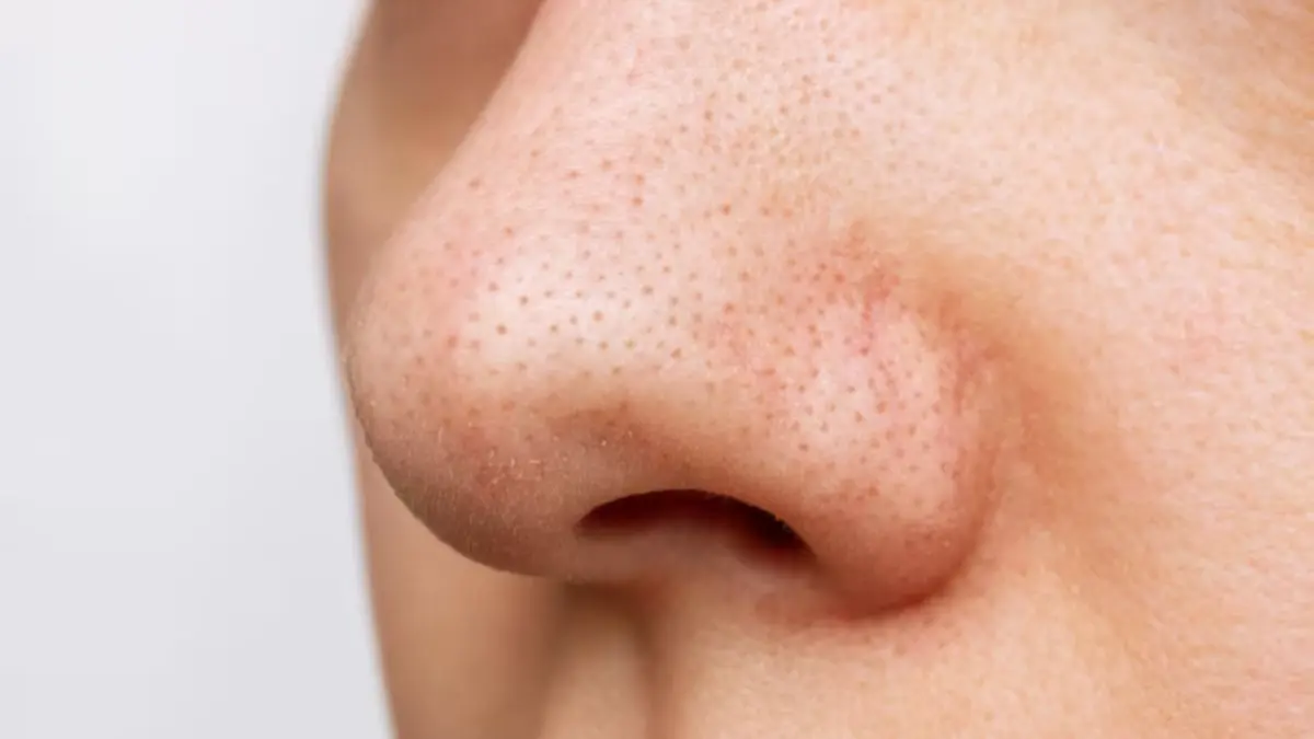 Whiteheads Vs Blackheads: What Are The Causes And How To Treat Them Whiteheads Vs Blackheads