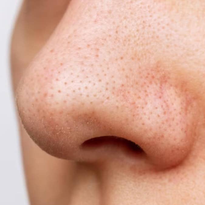 Whiteheads Vs Blackheads