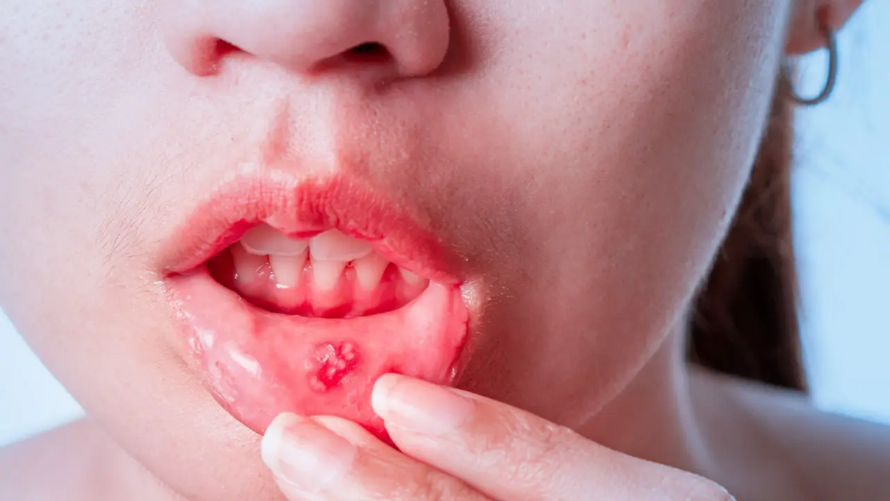 Mouth Ulcers