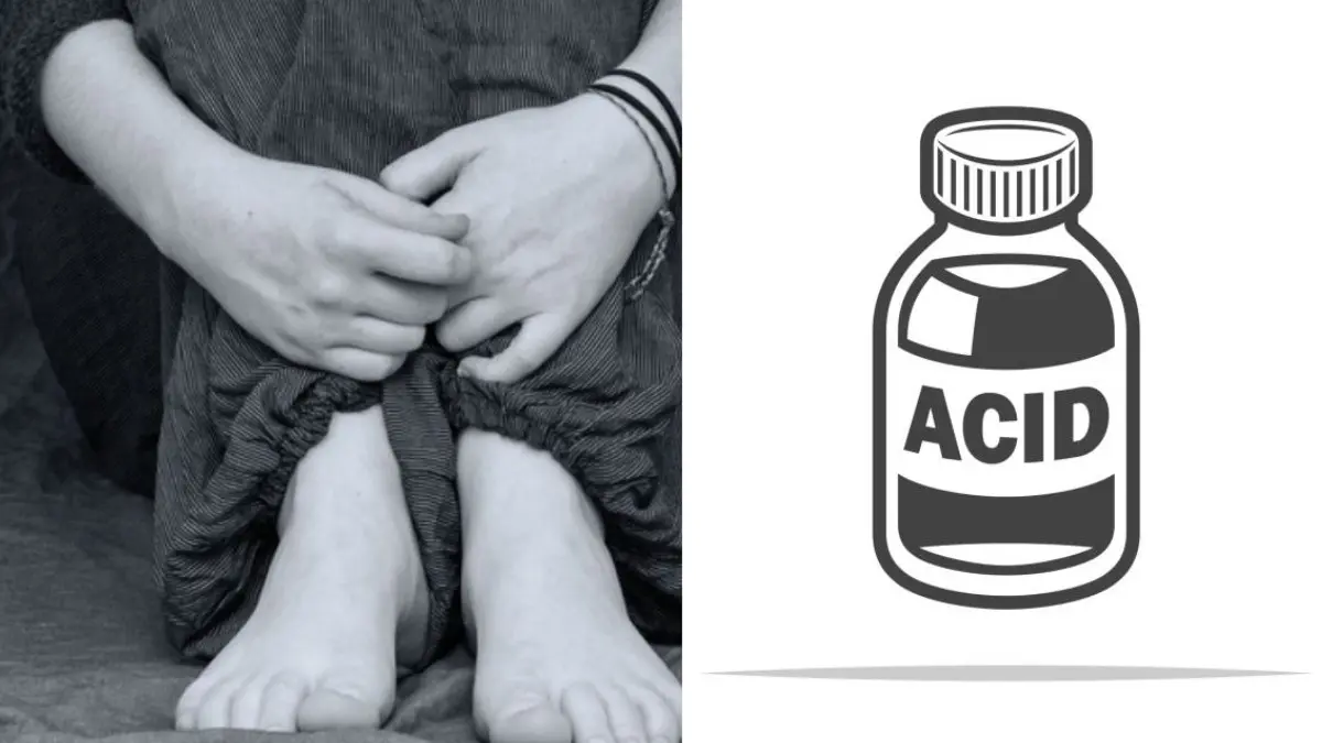 Delhi Student Attacked With Acid Outside College By Stalker In Ashok Vihar, Police Launch Manhunt