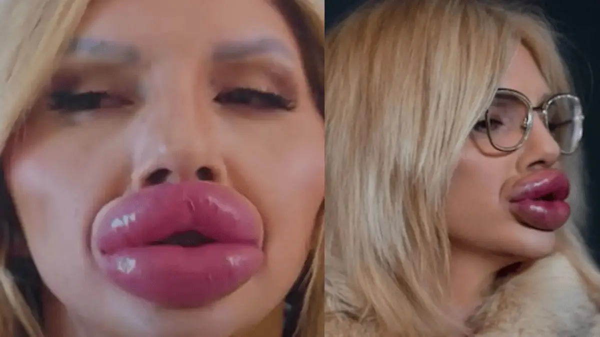 A social media influencer spent Rs 1.3 Crore on surgeries to get the ‘World’s Biggest Lips’