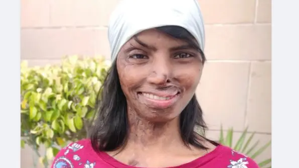 acid attack victim seema and Roop Ram Story
