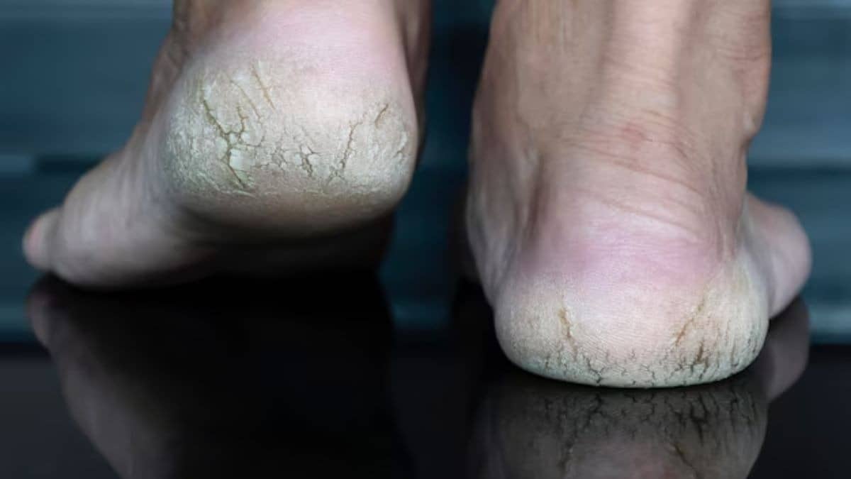 Aloe Vera for Cracked Heels