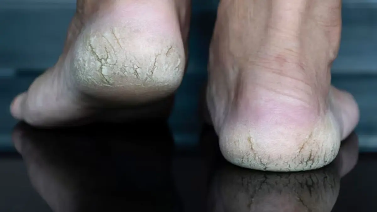 Aloe Vera for Cracked Heels