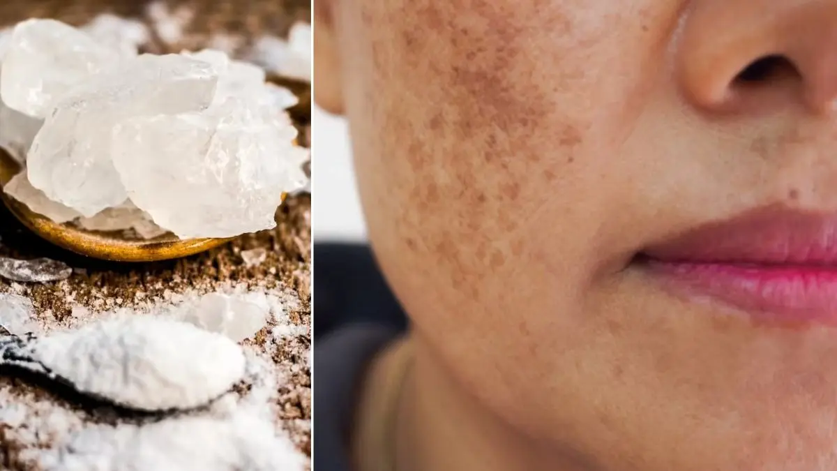 alum for facial freckles