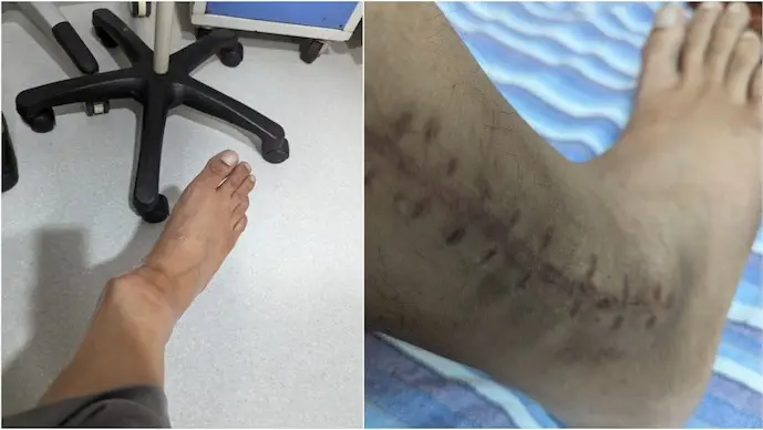 An Indigo passenger took to X and described his traumatic experience blaming the airline for an ankle injury.