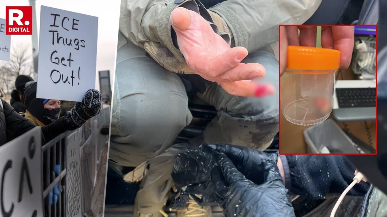 Anti-ICE Protests: Federal Officer's Finger Bitten Off Amid Alex Pretti Shooting Row