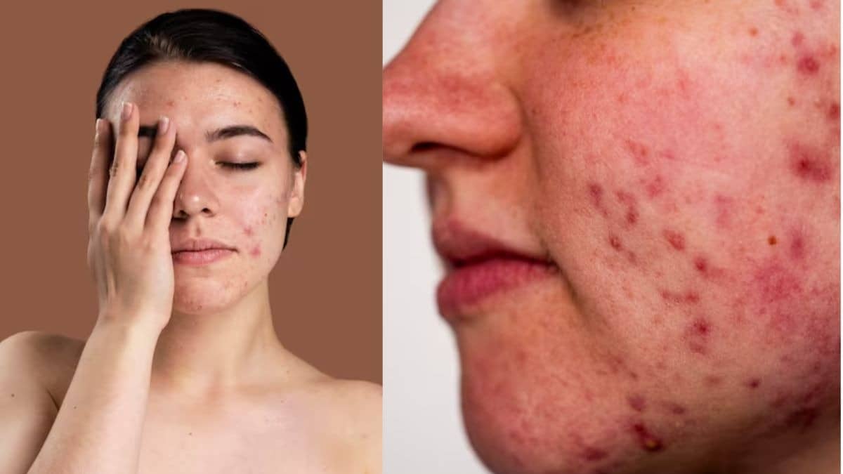 avoid these habits that can cause pimples and acne on face tips for beautiful skin