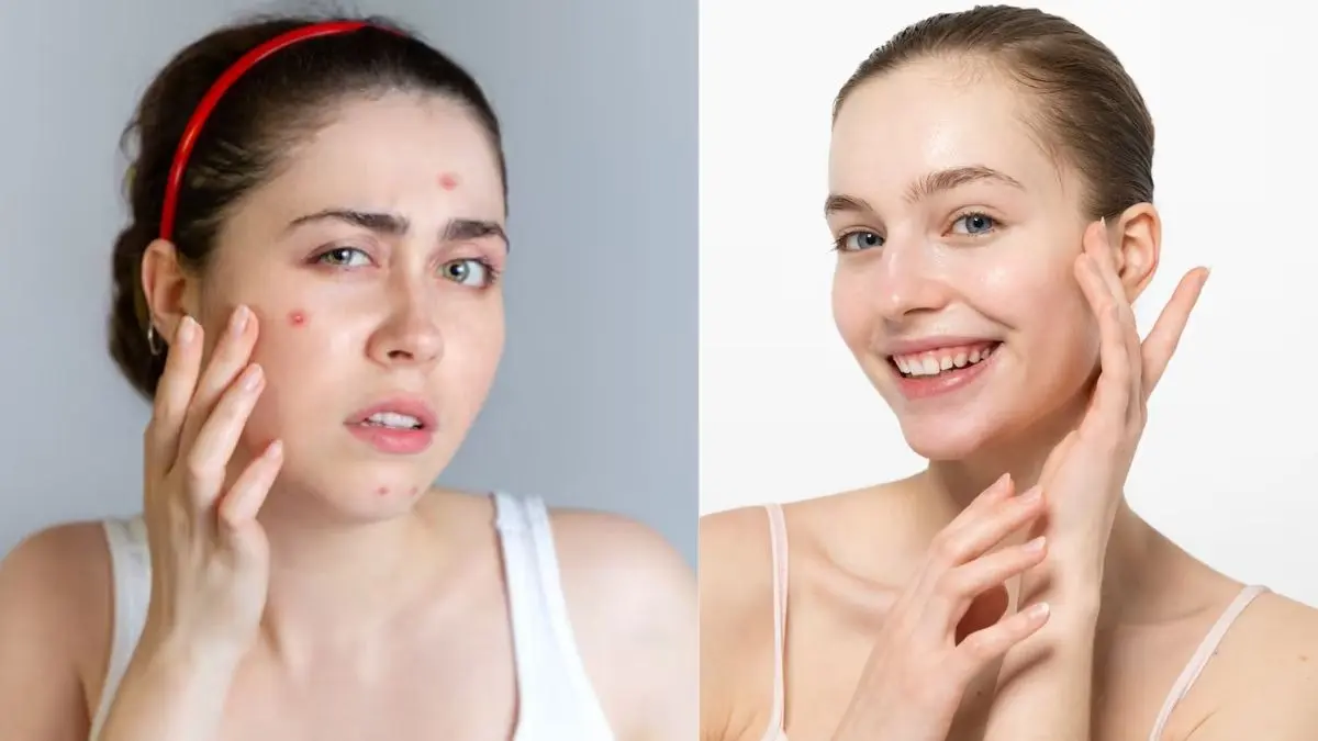 Natural Face Pack: खत्म होंगें एक्ने और ऑयली स्किन, चेहरे का ग्लो आएगा वापस, छुटकारा दिलाएगा बेसन-नींबू का यह नुस्खा besan lemon face pack benefit