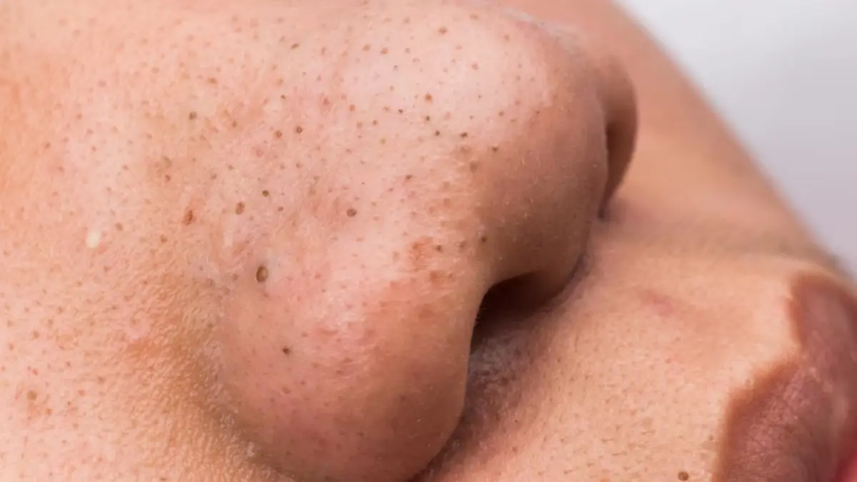 Blackheads