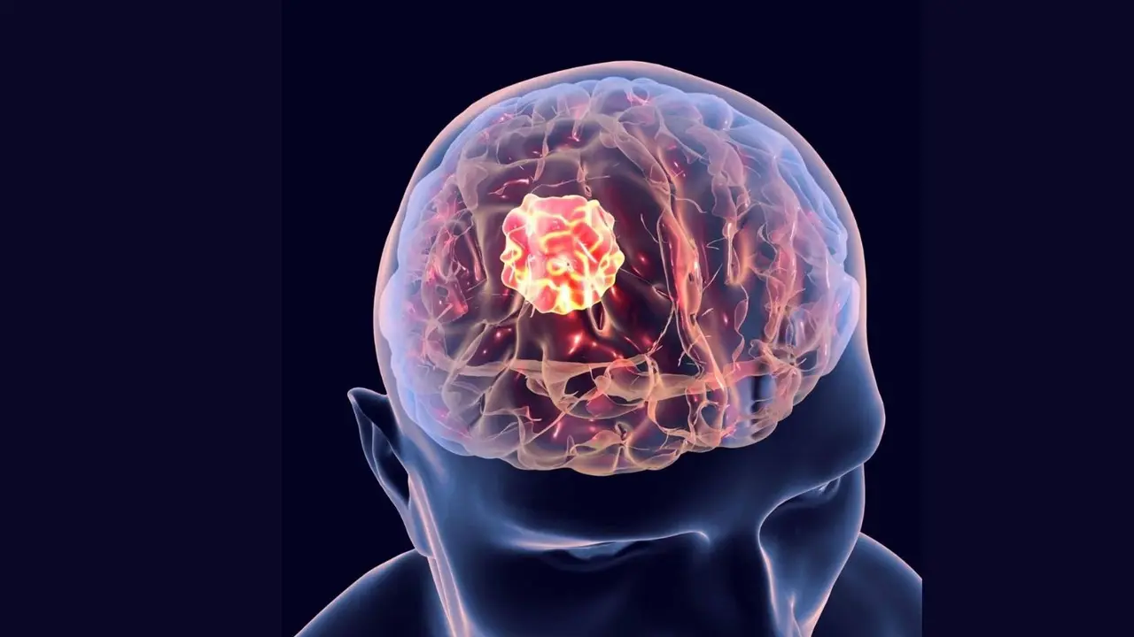 Critical to spot the warning signs early to stop brain tumor progression Brain Tumour