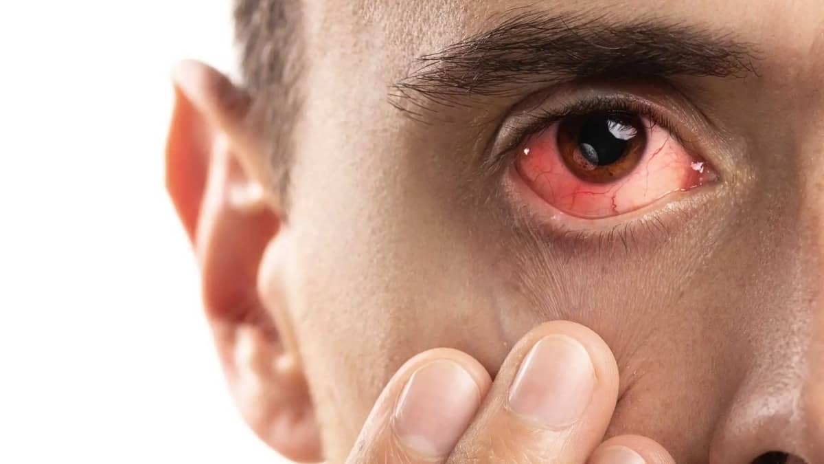 Corneal infection causes redness in the eye among other symptoms