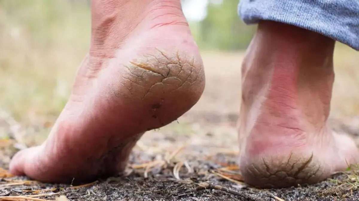 Cracked heels
