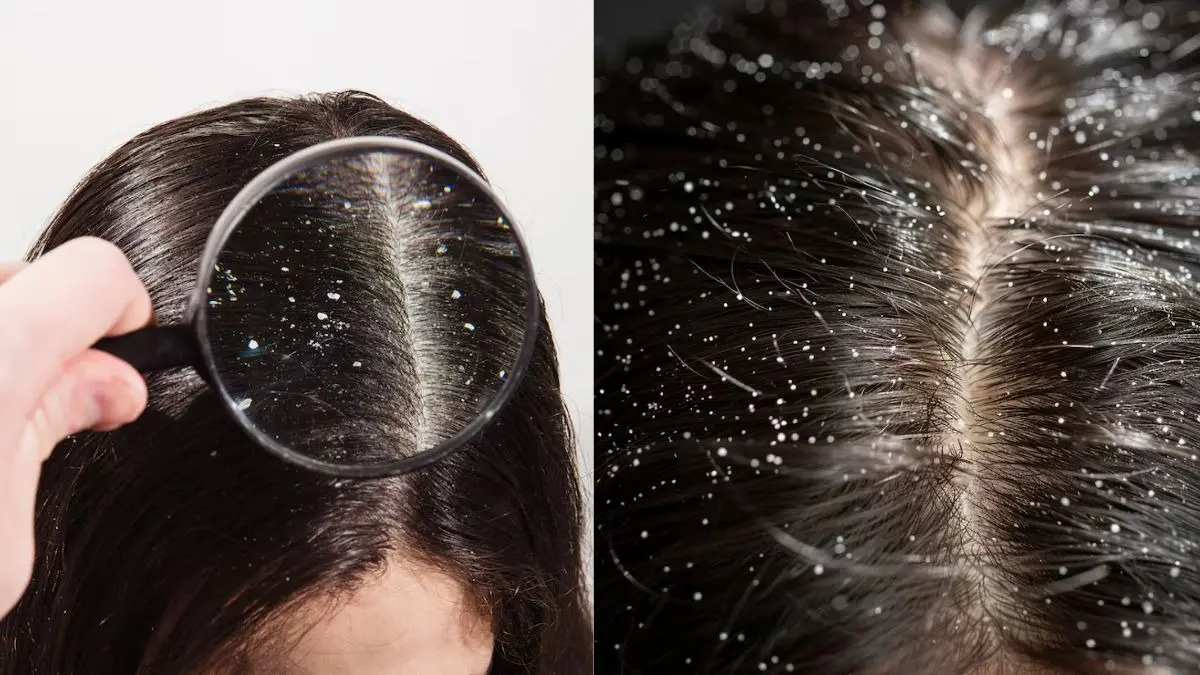 Dandruff Kaise Hataye: बालों से डैंड्रफ हटाने के लिए करें ये 4 घरेलू नुस्खे, दिखने लगेगा असर Dandruff Kaise Htaye