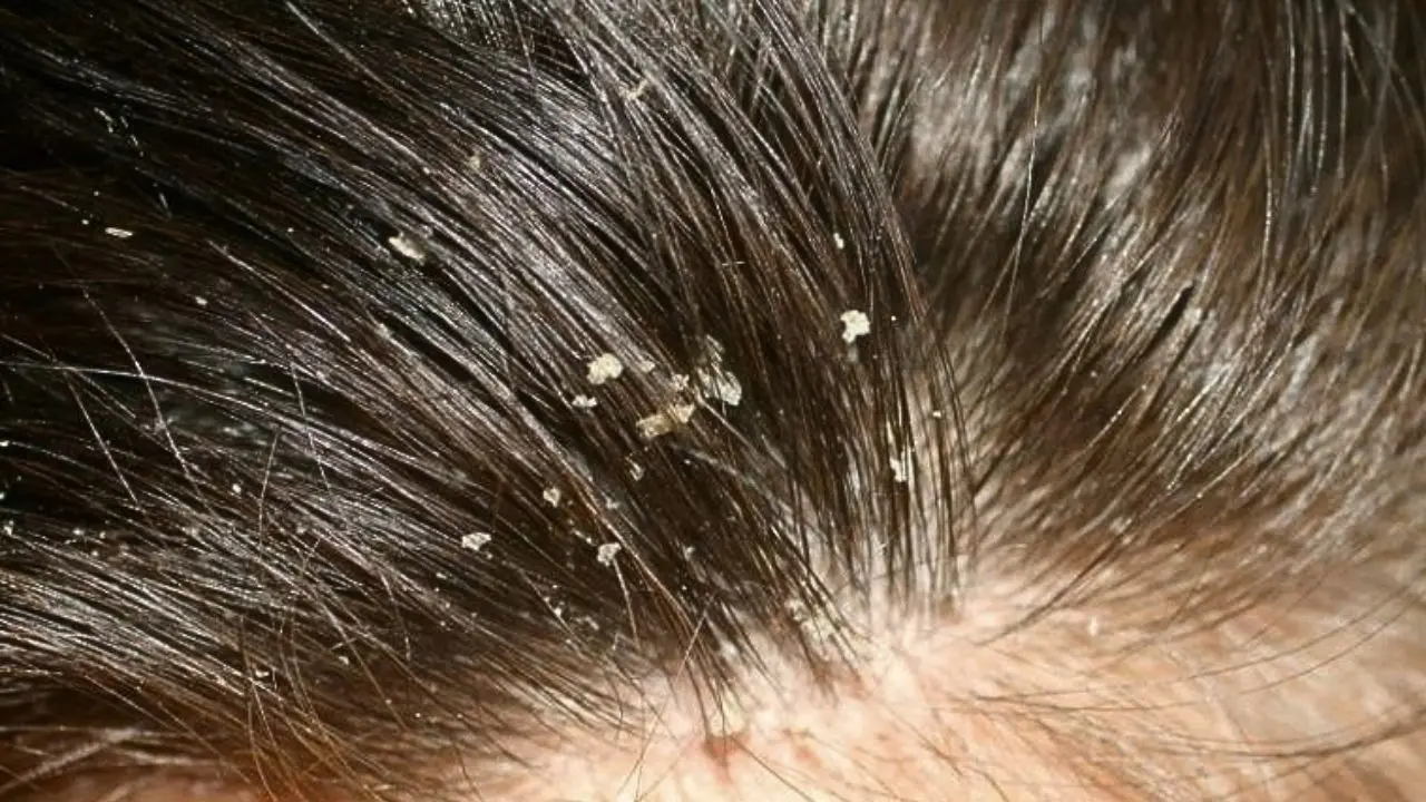 Dandruff Remedies