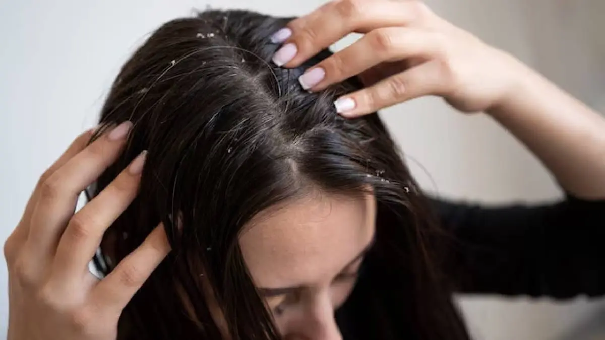 Dandruff Treatment at Home