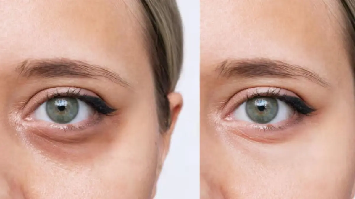 dark circles removal tips