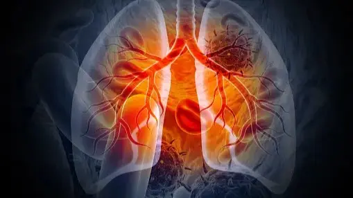 Is Black Mucus Indicative Of Lung Cancer? Causes, Symptoms And Prevention Does black mucus lead to lung cancer ?