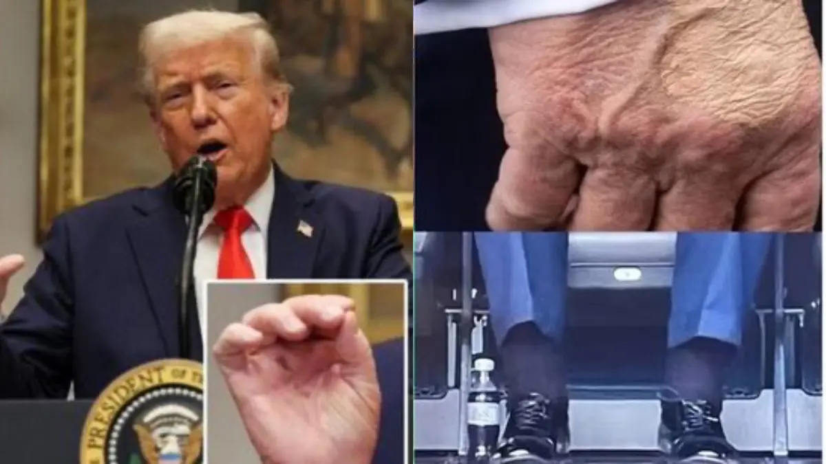 Donald Trump, CVI, Chronic Venous Insufficiency