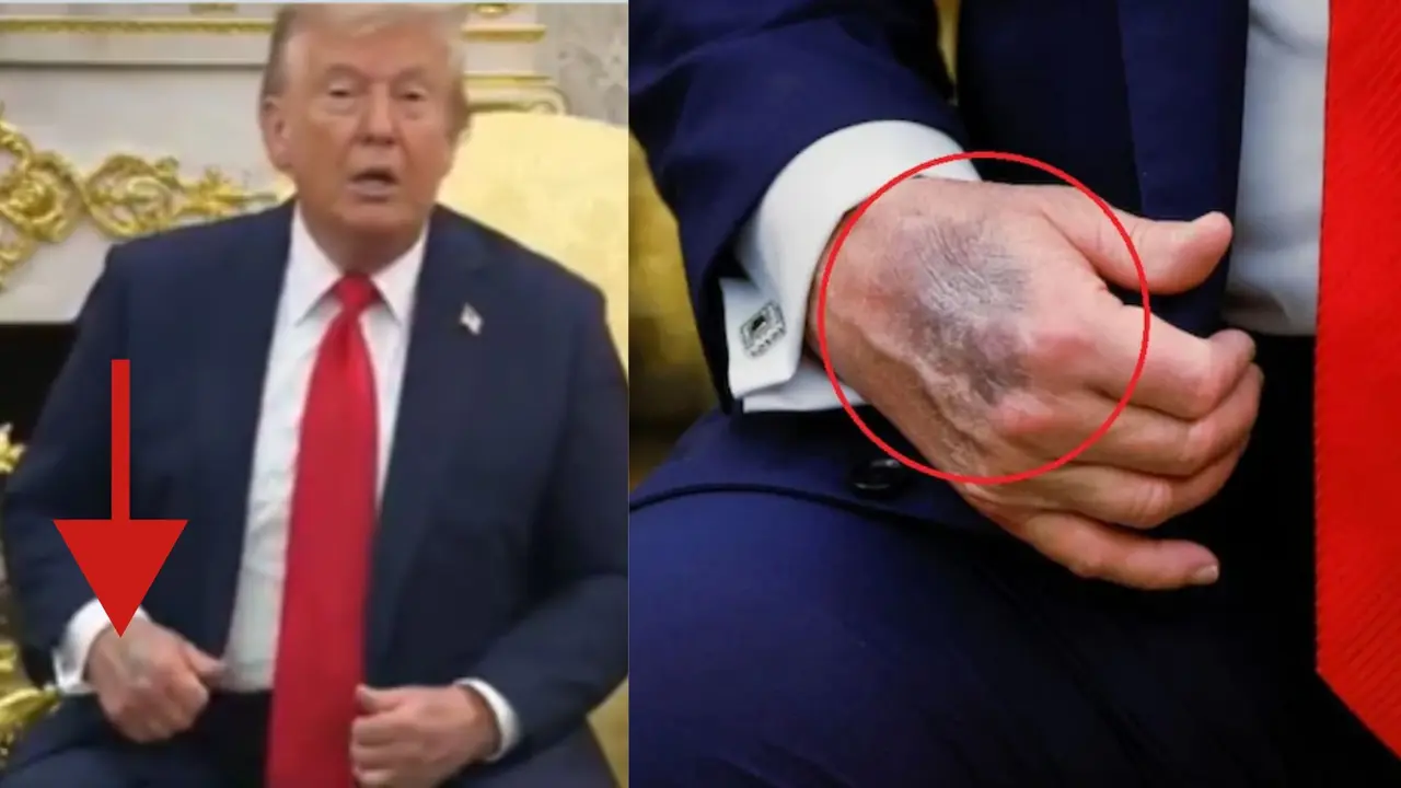 Donald trump right hand black spot health concerns heart attack medicine