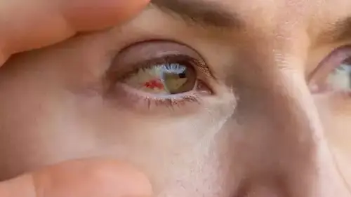 Has Fatal Marburg Virus Or Bleeding Eye Virus Reached India? Symptoms, Precautions, Treatment Eye Bleeding Virus