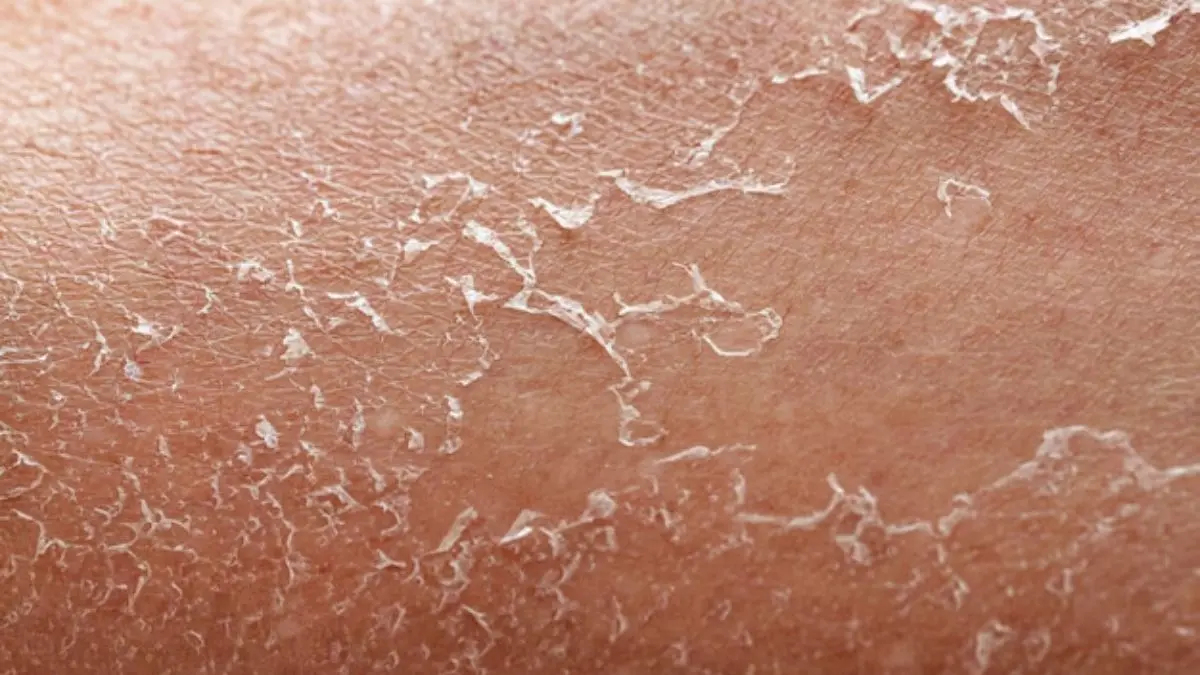 Home Skin Treatment: फ्लीकी और झुर्रियों वाली स्किन से हैं परेशान? तो अपनाएं ये 5 असरदार घरेलू नुस्खे, लौटाएंगे नमी flaky skin treatment