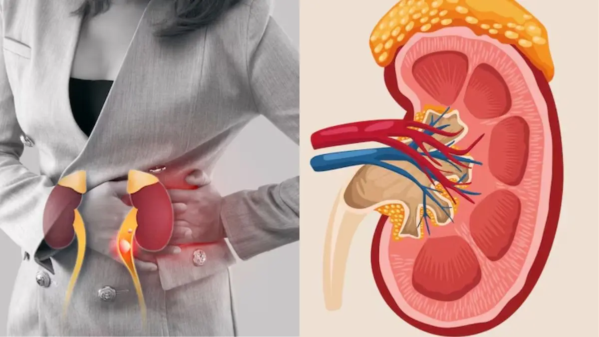 foods to avoid for kidney stone pathri me kya nahi khana chahiye