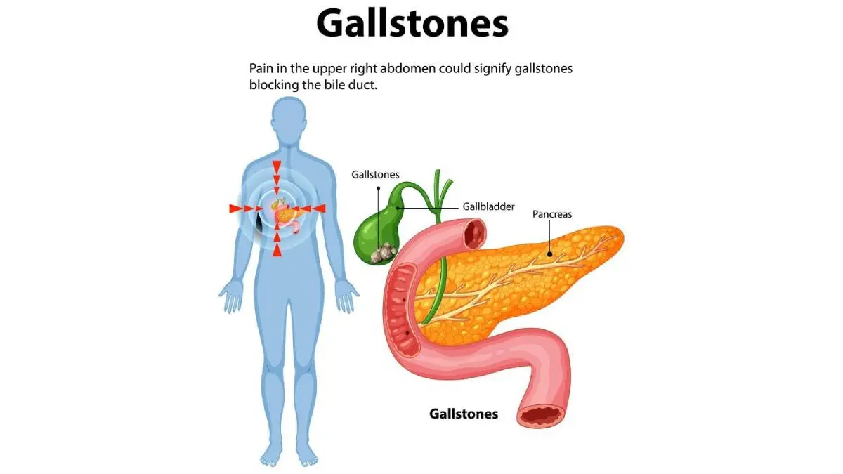 gallbladder stone