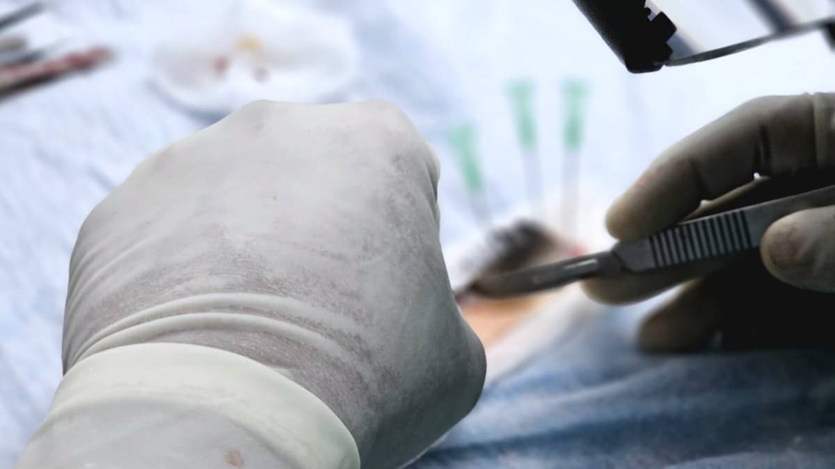 Hair Transplant By Dentist Turns Deadly For Two Kanpur Engineers