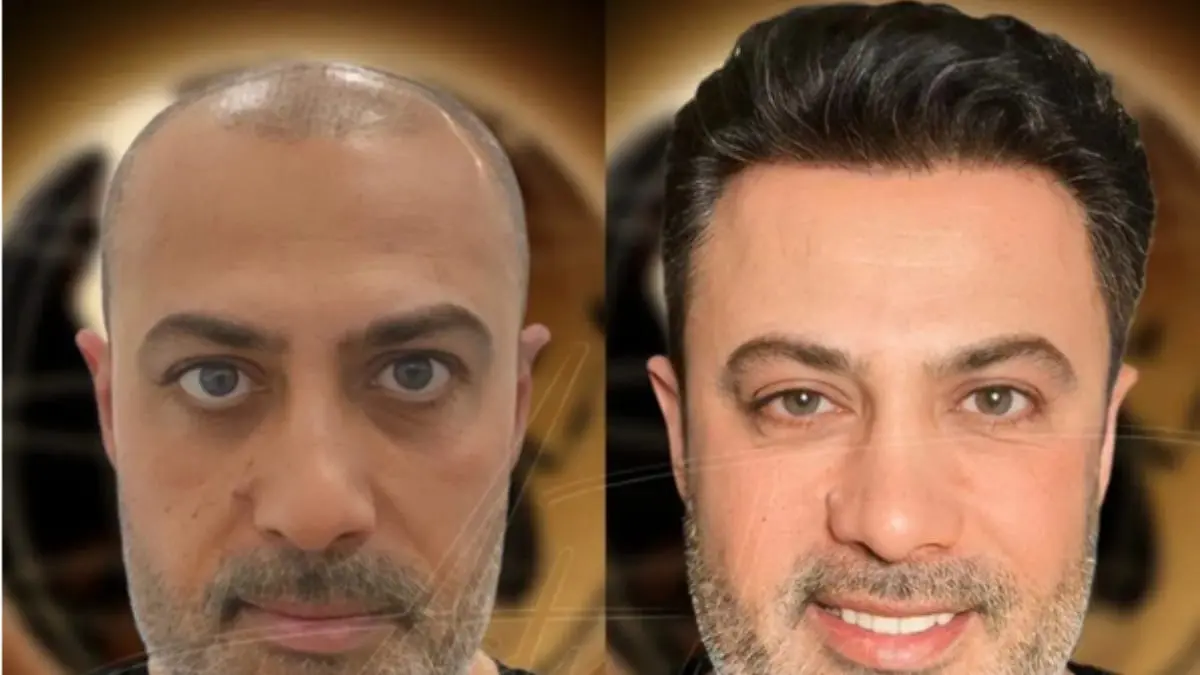 Hair Transplant Turkey Before and After Results to Expect Hair Transplant