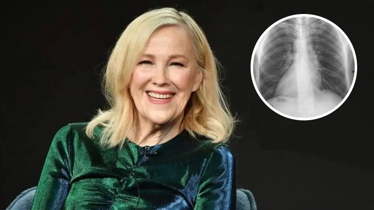 What Is Dextrocardia, The Rare Congenital Heart Condition That Ailed Catherine O’Hara? Hollywood star Catherine O'Hara suffered from dextrocardia since birth