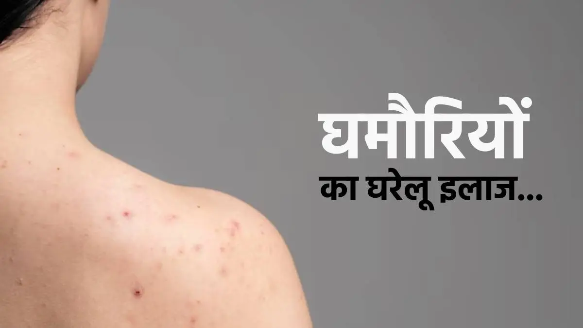 Home Remedies for Heat Rash