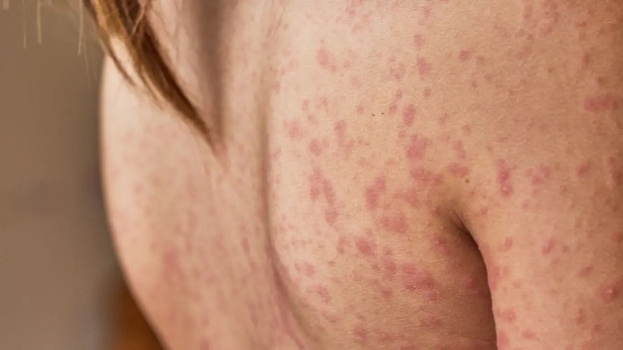 home remedies for heat rash