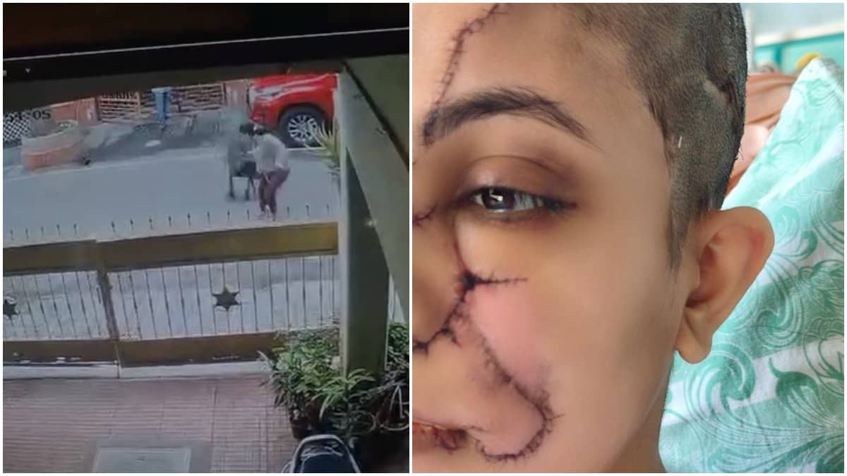 Horrific Video Captures Pet Dog’s Brutal Attack On Woman In Bengaluru Leaving Her With Over 50 Stitches On Face And Head