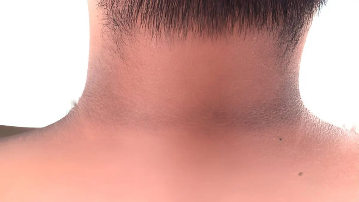 how to get rid of blackness of neck using curd and honey home remedy