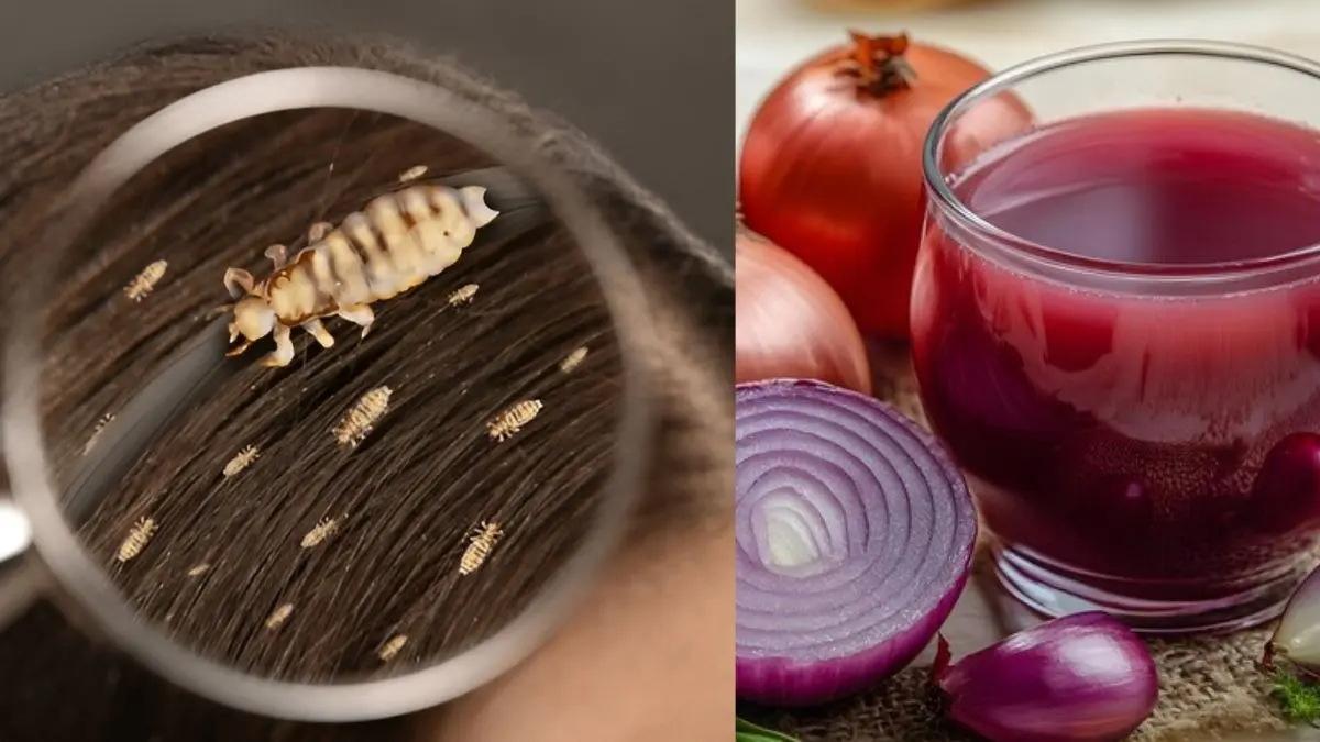 how to get rid of lice from hair using onion juice on scalp to length