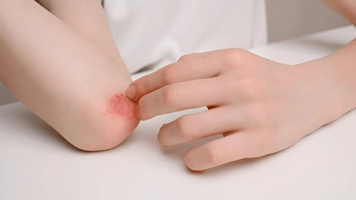 how to prevent skin peeling in monsoon season and how to take care of your skin