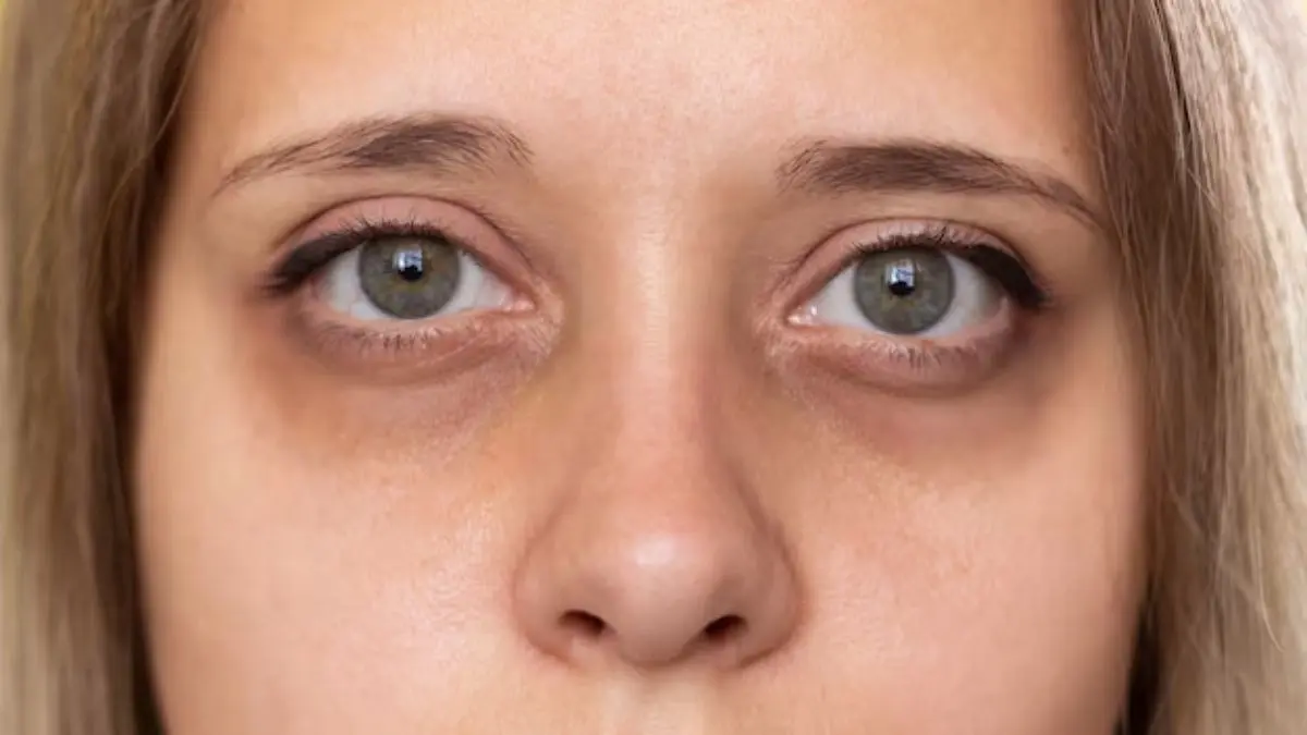 Dark Circles: आंखों के नीचे से डार्क सर्कल्स हटाने के लिए क्या लगाएं? जानें आसान घरेलू उपाय how to reduce dark circles from under eye area using cucumber and aloe vera gel