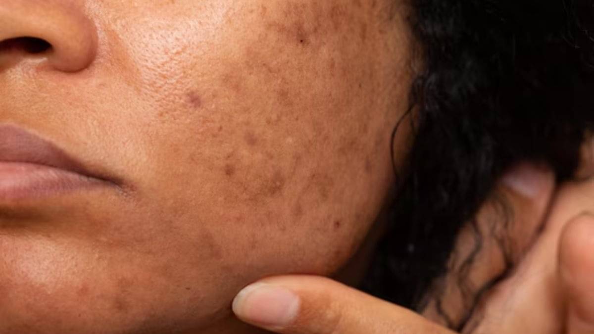 how to reduce pigmentation from skin to look young and beautiful 